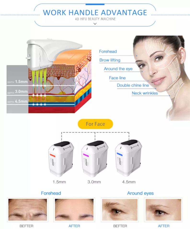 4D HIFU for Face Body Viginal