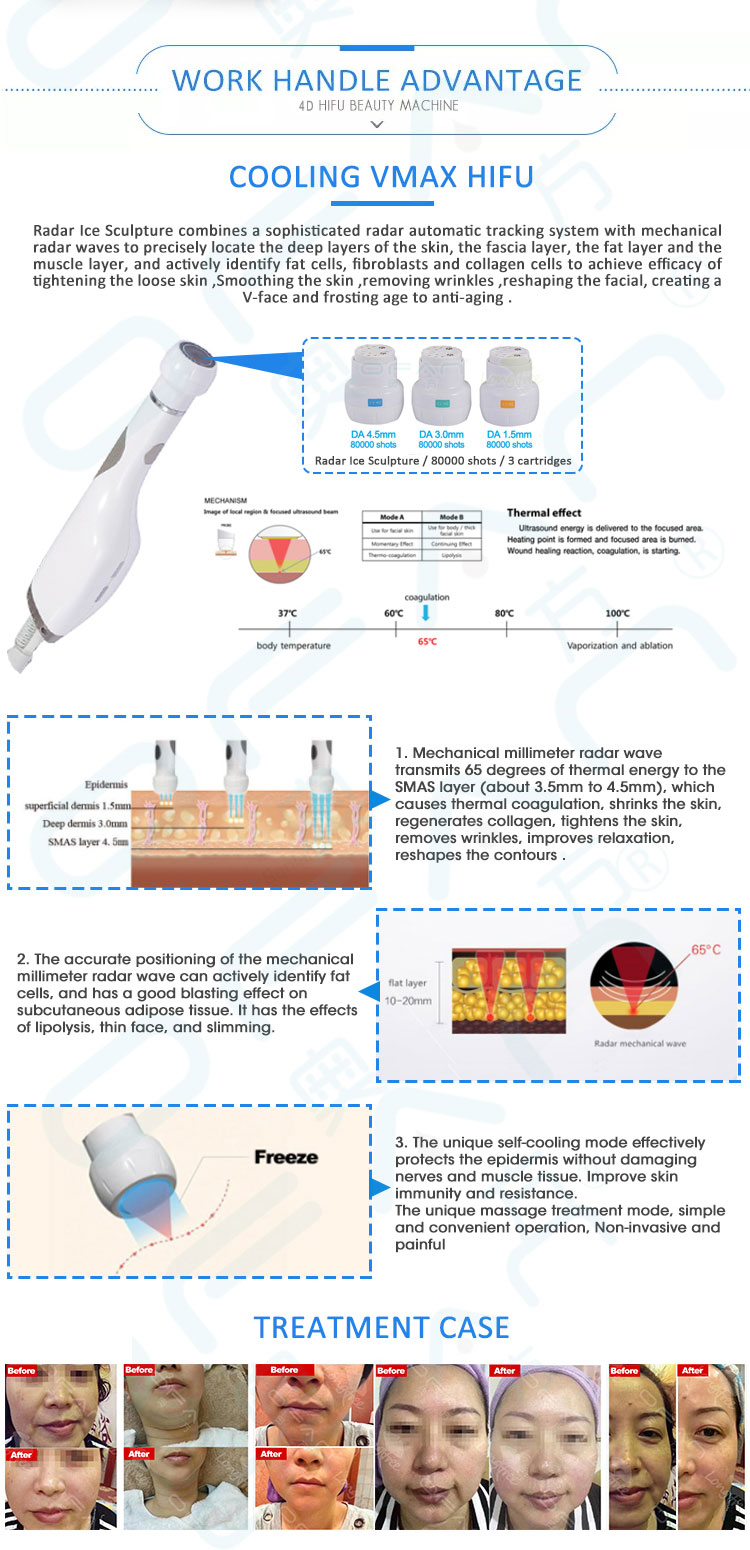 4D HIFU  Freezing Vmax HIFU