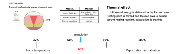 Freezing Vmax HIFU