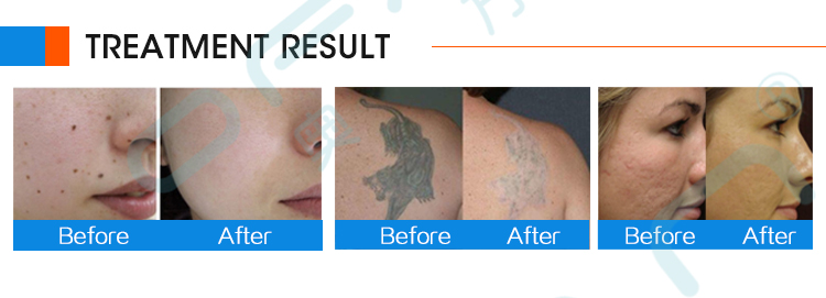 Picosecond Portable Charge Laser Blemish Acne and Tattoo Removal