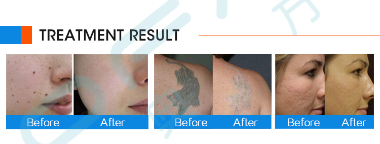 Picosecond Portable Laser Blemish Acne and Tattoo Removal