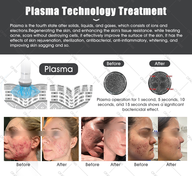 Equipo portátil de belleza con plasma para el cuidado de la piel antiinflamatorio y para eliminar el acné