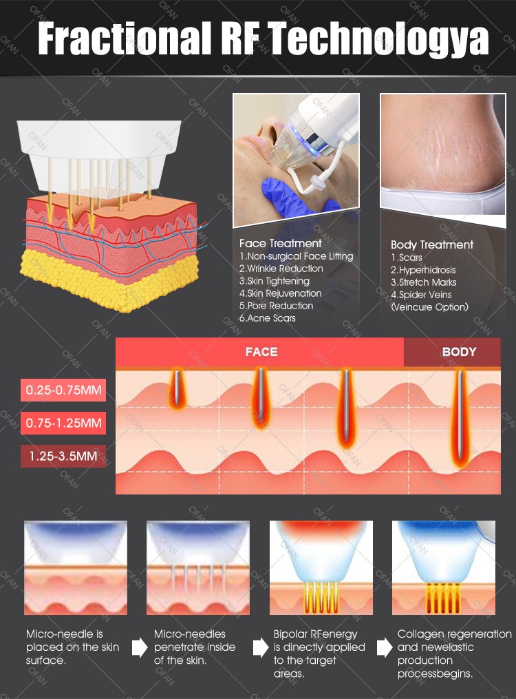 RF Fraccional Portátil